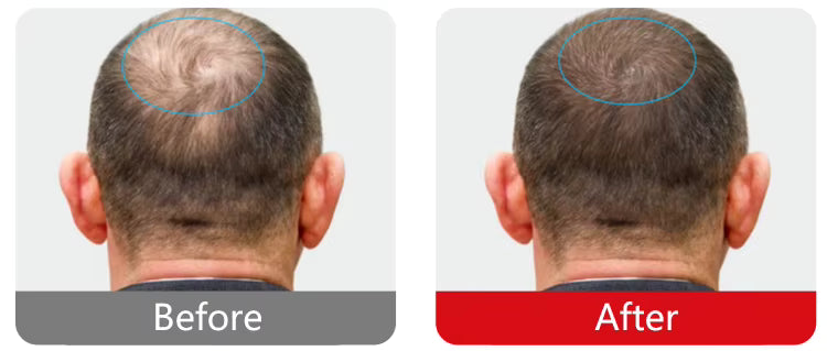 InzysJointRelief - Ultimate Strength Cold Laser Therapy Device & LLT Hair Comb
