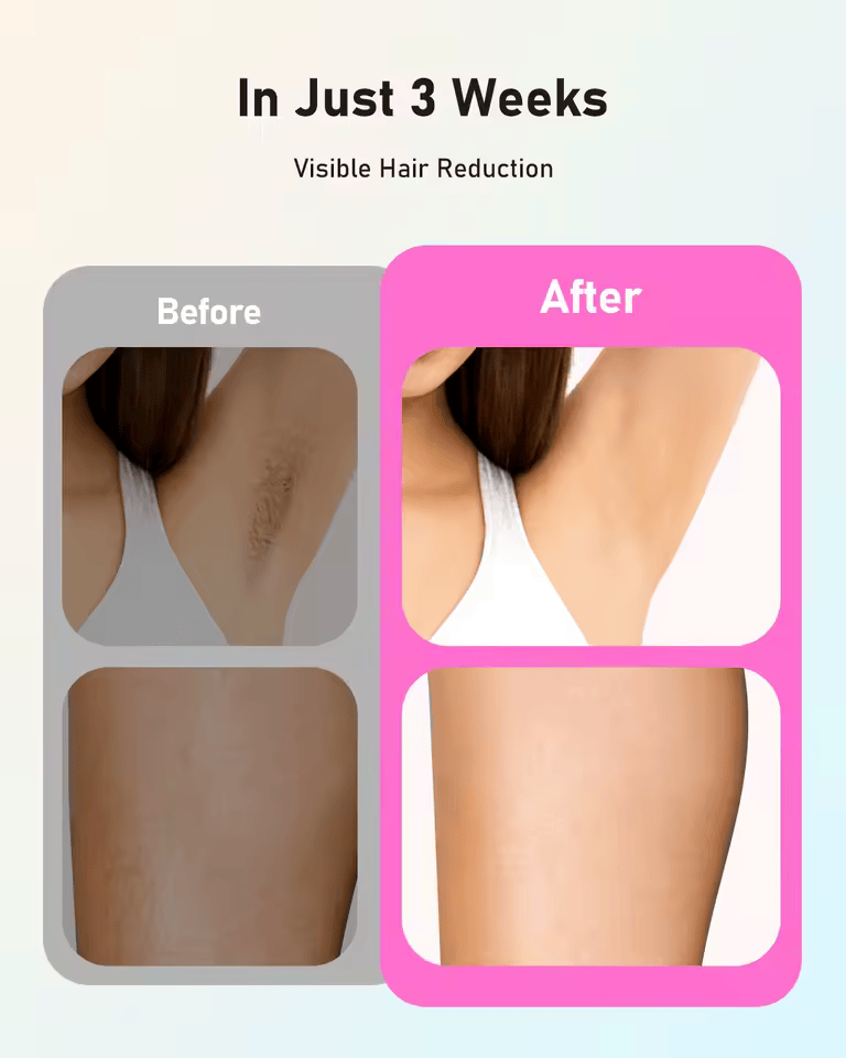 InzysLaserIPL - Professional IPL Hair Removal Laser 5.0
