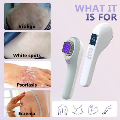 InzysJointRelief - 308nm UVB Lamp for Vitiligo Phototherapy Light Therapy for Psoriasis - InzysJointRelief