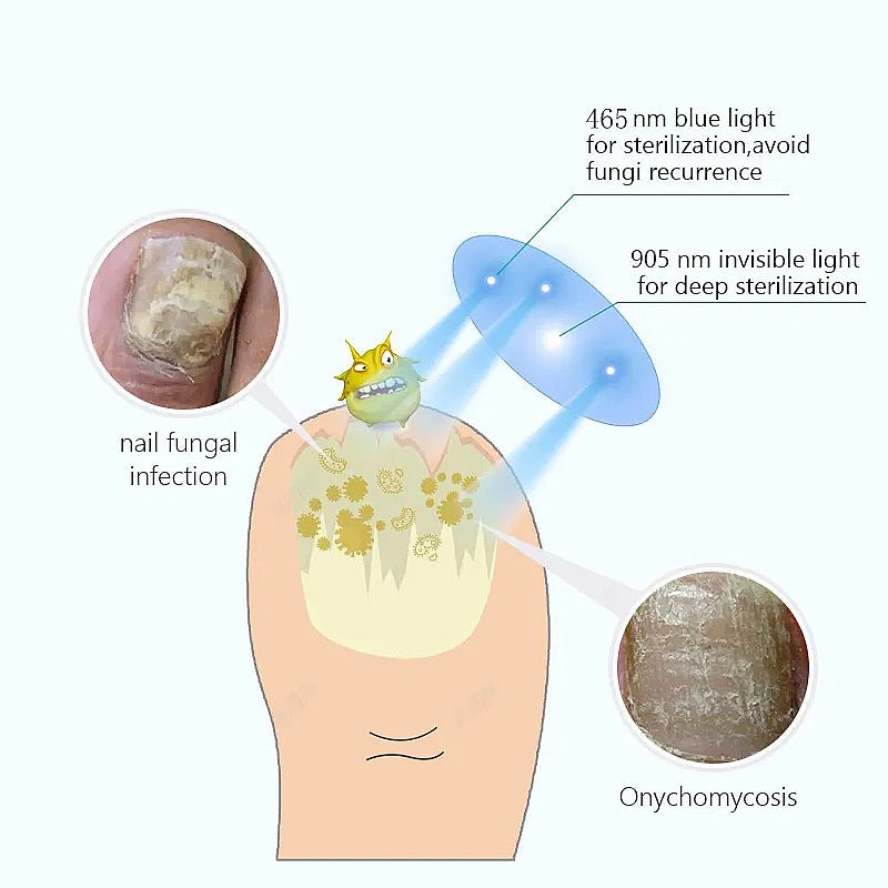 InzysJointRelief - Toenail Fungus Laser Therapy Device - InzysJointRelief