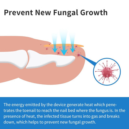 InzysJointRelief - Toenail Fungus Laser Therapy Device for Onychomycosis - InzysJointRelief